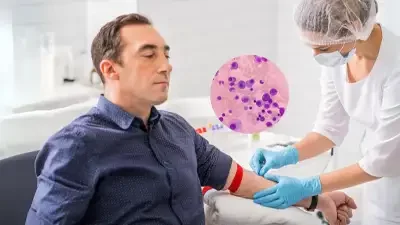 Cemmp-Mieloma Múltiple-el cáncer a la sangre que afecta en un 57% a hombres mayores de 60 años