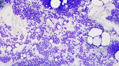 Cemmp-Noticia-La CAR-T cilta-cel mejora significativamente la supervivencia libre de progresión en pacientes con mieloma múltiple de alto riesgo