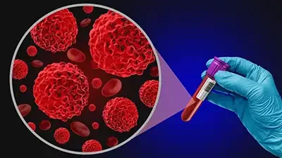 Cemmp-Noticias-Leucemia, linfoma y mieloma múltiple-síntomas que avisan de un cáncer sanguíneo